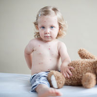 Los movimientos antivacunas son la principal causa del brote de sarampión en Europa, según los expertos