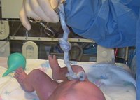 Casi la mitad de los padres han conservado las células madre del cordón umbilical del bebé al nacer