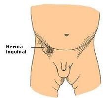 La hernia inguinal