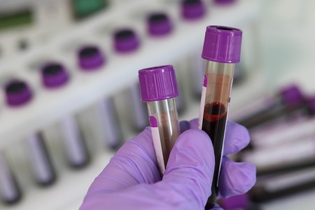Hay gente que está pagando hasta 12.000 dólares por una transfusión de sangre joven con la promesa de frenar el envejecimiento