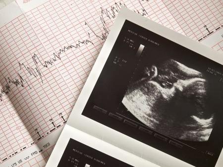 La monitorización fetal antes del parto, ¿para qué sirve?