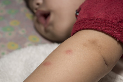 Picaduras de insectos en bebés y niños, ¿qué hacer y cómo prevenirlas?