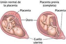 La placenta previa es más frecuente en los bebés in vitro