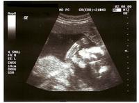 Pruebas en el embarazo: detección de anomalías cromosómicas 