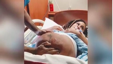 Impresionante vídeo de una versión cefálica externa para dar vuelta al bebé que viene de nalgas