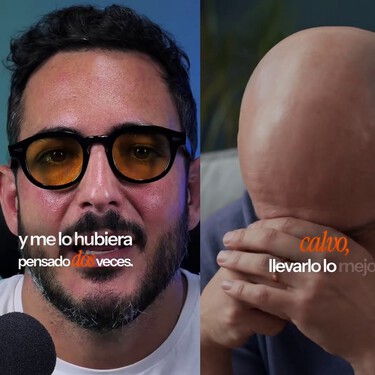 Un especialista en trasplantes de pelo alerta sobre las complicaciones de la cirugía más demandada y se arrepiente: "si yo pudiera volver atrás hoy quizá no me lo haría" 