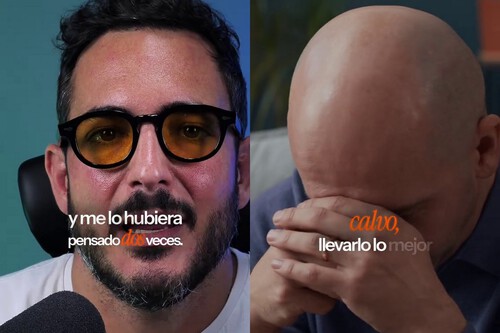 Un Estudioso De Los Trasplantes De Pelo Avisa De Los Problemas Que Conllevan Si Yo Pudiera Volver Atras Hoy Quiza No Me Lo Haria Y Me Lo Hubiera Pensado Dos Veces