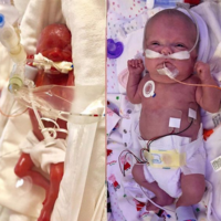 La madre de una bebé prematura comparte el increíble cambio de su hija tres meses después de haber nacido