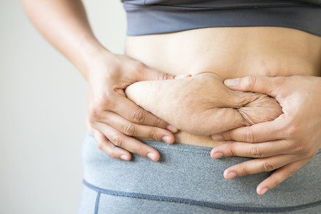 Mujer Estrias Barriga