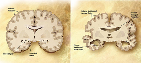 Este análisis de sangre tiene un 94% de precisión para identificar la enfermedad de Alzheimer temprana