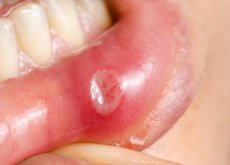 Y garganta herpes en boca la