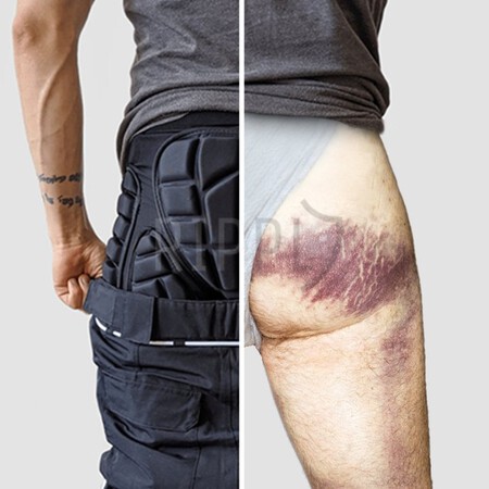 On The Right You See The Aftermath Of A Hard Fall On The Slopes A Set Of Bruises That Could Have Been Avoided It S A Painful Reality But It Doesn T Have To Be Your Reality On The Left Here S One Smart Dude Ge