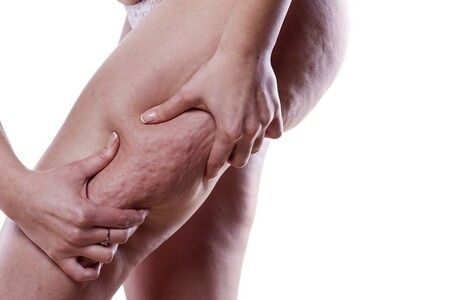 Alimentación y celulitis, ¿es posible deshacernos de ella con una dieta adecuada?