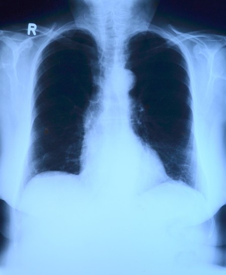 Algunos medicamentos para la presión arterial aumentan el riesgo de cáncer de pulmón