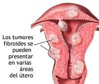 Complicaciones en el embarazo a causa de los tumores fibroides
