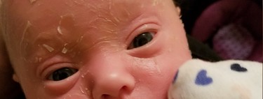 El extraño caso de Amelia, la pequeña con ictiosis laminar cuya piel se asemeja a las escamas de un pez