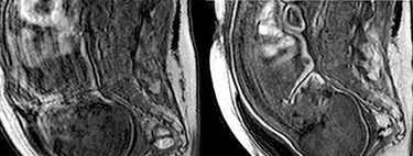 Así se deforma la cabeza del bebé durante el parto para facilitar su paso por la pelvis materna