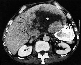 Estrógenos frente al cáncer de hígado