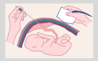 Pruebas prenatales VI: Cordocentesis