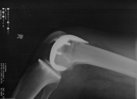 Artrosis: desequilibrio articular