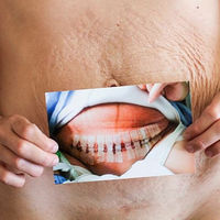 El bonito homenaje de una madre a la cicatriz de su cesárea después de trillizos