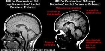 Síndrome alcohólico fetal (SAF)