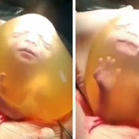 Impresionante nacimiento por cesárea en el que el bebé sale dentro de la bolsa amniótica 