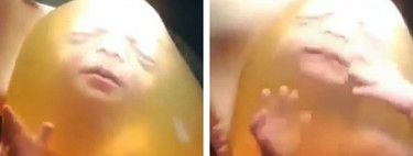 Impresionante nacimiento por cesárea en el que el bebé sale dentro de la bolsa amniótica 
