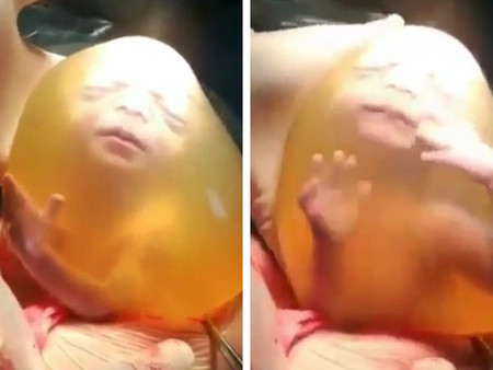 Impresionante nacimiento por cesárea en el que el bebé sale dentro de la bolsa amniótica