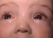 Detectar la conjuntivitis infantil