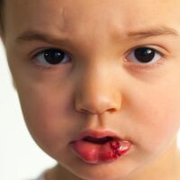 El niño se ha hecho un corte en el labio, ¿cómo curarle?
