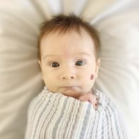 Angiomas o hemangiomas en bebés y niños: por qué se producen y cómo se tratan estas malformaciones en la piel