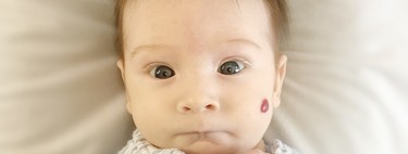 Angiomas o hemangiomas en bebés y niños: por qué se producen y cómo se tratan este tipo de manchas en la piel