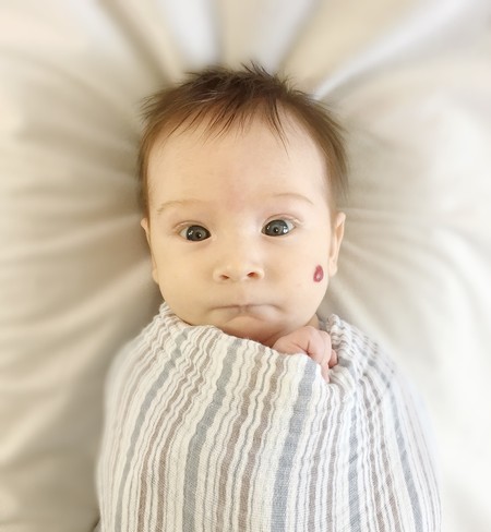 Angiomas o hemangiomas en bebés y niños: por qué se producen y cómo se tratan este tipo de manchas en la piel