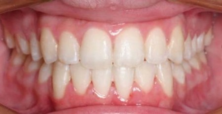 Los cubiertos de tu mesa, ¿responsables de la forma de tu dentadura?