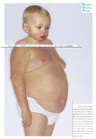 El 10% de los niños de 3 a 12 años son obesos