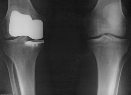Maneras más habituales de provocarnos una lesión de ligamentos en la rodilla