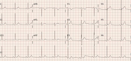 Electrocardiograma