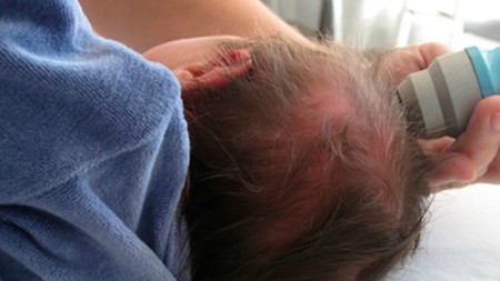 Neosonics en la cabeza de un bebé