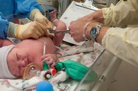 ¿Vale la pena congelar células madre del cordón umbilical? (II)