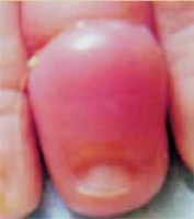 Síndrome del torniquete en los bebés: ojo con los hilos y los pelos