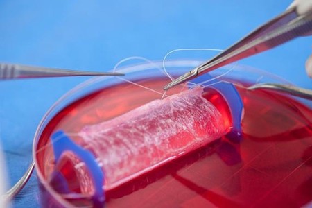 Se implantan en cuatro adolescentes las primeras vaginas artificiales