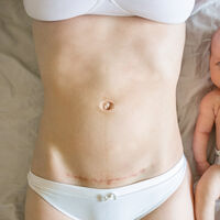 ¿Cuántas cesáreas puede tener una mujer?