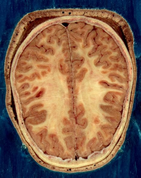 Nueva técnica para suprimir los efectos de la esquizofrenia: resincronización de neuronas
