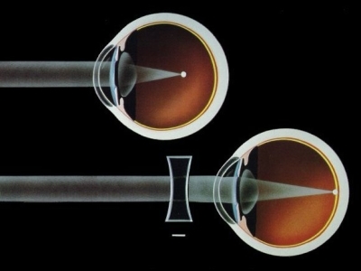La cirugía ocular LASIK