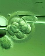 La exotosis múltiple evitada gracias al diagnóstico preimpantacional