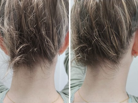 Nuca Dermatitis Cuero Cabelludo