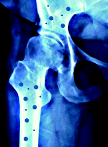 La anorexia en la juventud aumenta la aparición de la osteoporosis con la llegada de la menopausia (I)