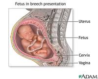 Que el bebé venga de nalgas ya no es motivo para hacer una cesárea (en Canadá)