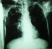 ¿Viagra para los pulmones?